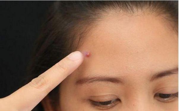 额头痤疮怎么办，额头上长痤疮怎么办（4个方法助你去除额头痘）