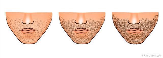 雄性激素过高会怎样，雄激素过高是怎么回事（女生汗毛变密、声音变粗）