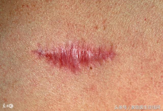 伤疤怎么能去掉，受伤后的疤痕怎么能消除（专门祛除各种顽固性疤痕）