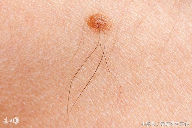 痣上的毛怎么去除，痣上长毛怎么办（用错方法可能会导致恶变）