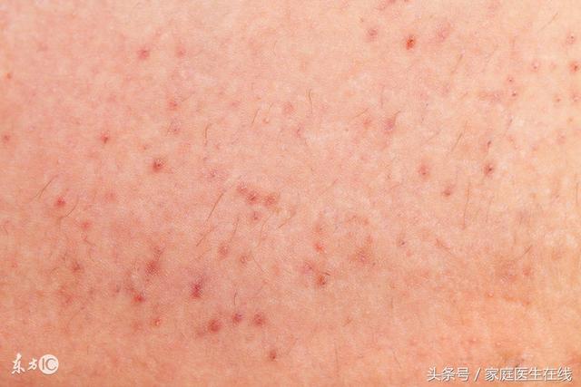 痣上的毛怎么去除，痣上长毛怎么办（用错方法可能会导致恶变）