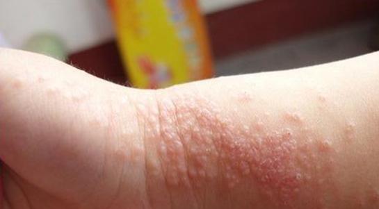 氢化泼尼松的作用，氢化泼尼松的作用机制（脂溢性皮炎怎么控制）