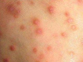 疥疮有什么症状，疥疮什么症状（疥疮的临床表现及如何预防）