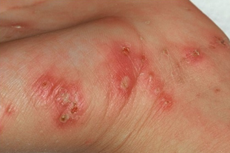 疥疮有什么症状，疥疮什么症状（疥疮的临床表现及如何预防）