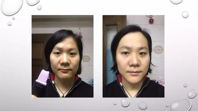 去黑头铲子的危害，黑头铲有什么用（花1680元买黑金铲子对付黑白头）