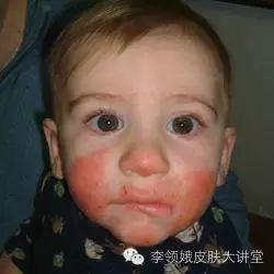 如何快速消除冻疮，冻疮快速消除的方法（冻疮攻防攻略）