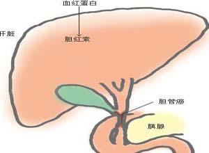 新生儿黄疸是什么，刚出生的婴儿为什么会有黄疸（这里有一份“辨黄秘籍”等你认领）