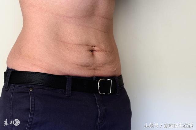 肥胖纹瘦了会消失吗，瘦了肥胖纹会消失吗（想肥胖纹消失的人注意）