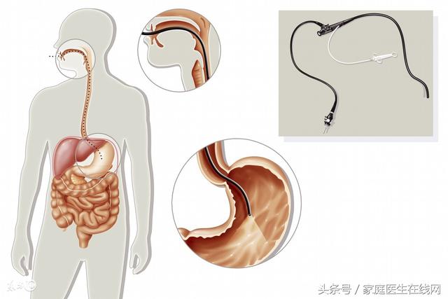 肠镜能查出什么，肠镜可以查出哪些疾病（这10类人定期做好肠镜检查）