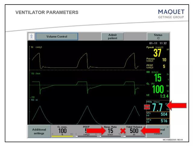 5个呼吸机常见参数设置，呼吸机各种模式需要调的参数（送给临床小白——呼吸机模式及参数设置图文详解）