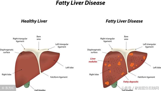 脂肪肝注意事项，脂肪肝应注意什么（得了脂肪肝，饮食要注意什么）