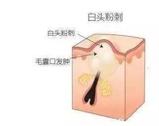 黑头和白头的区别，怎样区别角栓、黑头、白头、粉刺（黑头、白头、痘痘、粉刺）