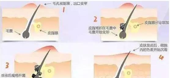 黑头和白头的区别，怎样区别角栓、黑头、白头、粉刺（黑头、白头、痘痘、粉刺）
