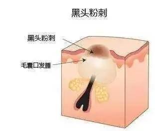 黑头和白头的区别，怎样区别角栓、黑头、白头、粉刺（黑头、白头、痘痘、粉刺）