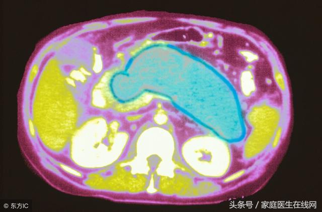 胰腺炎严重吗，胆结石引起的胰腺炎严重吗（急性胰腺炎死亡率为什么会这么高）