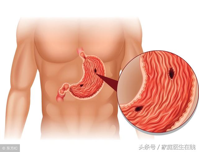 胃穿孔症状有哪些，胃穿孔为什么只可以活4年（你的胃已经在穿孔的路上了）