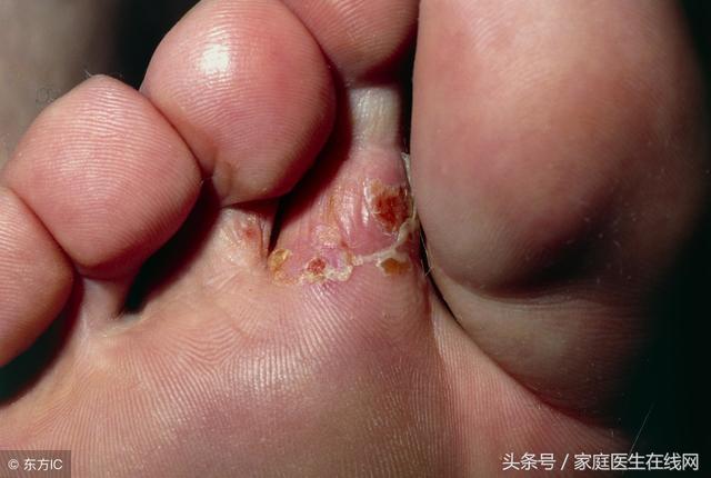治疗脚气的药膏，脚气用什么药膏（脚气和脚气病有什么不同）