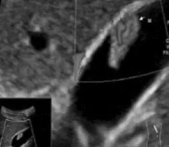 彗尾征是什么意思，肾结石后伴彗尾征是什么意思（有一份胆囊息肉摆在我面前）