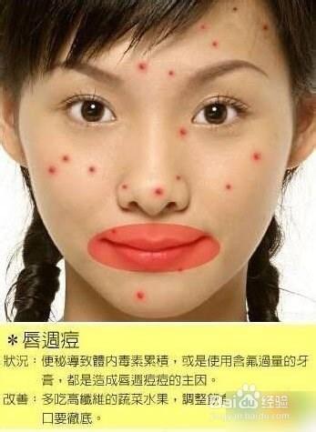 痘痘告诉你哪里生病了，脸上长痘痘怎么调理（长痘痘告诉你 身体哪里生病了）