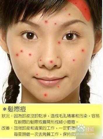 痘痘告诉你哪里生病了，脸上长痘痘怎么调理（长痘痘告诉你 身体哪里生病了）