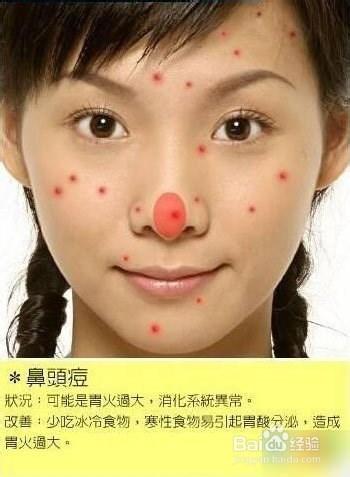 痘痘告诉你哪里生病了，脸上长痘痘怎么调理（长痘痘告诉你 身体哪里生病了）