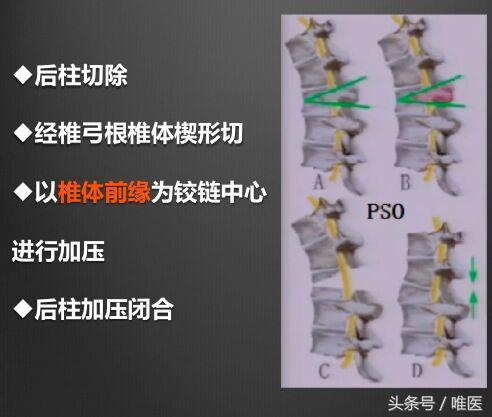 退变性脊柱侧弯：治疗篇-骨医小灶第十期Ⅳ