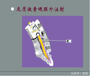 退变性脊柱侧弯：治疗篇-骨医小灶第十期Ⅳ