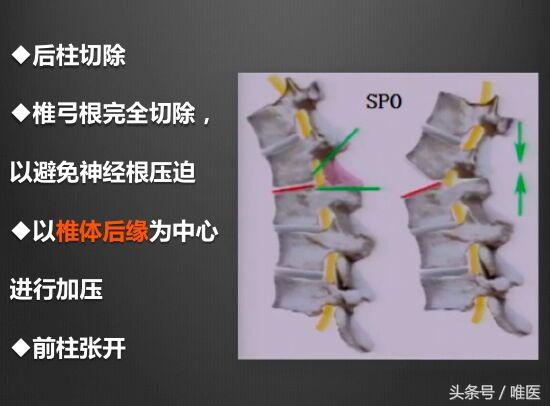 退变性脊柱侧弯：治疗篇-骨医小灶第十期Ⅳ