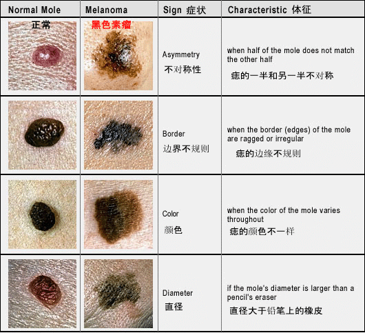 点痣安全吗？什么样的痣容易发生恶变呢？