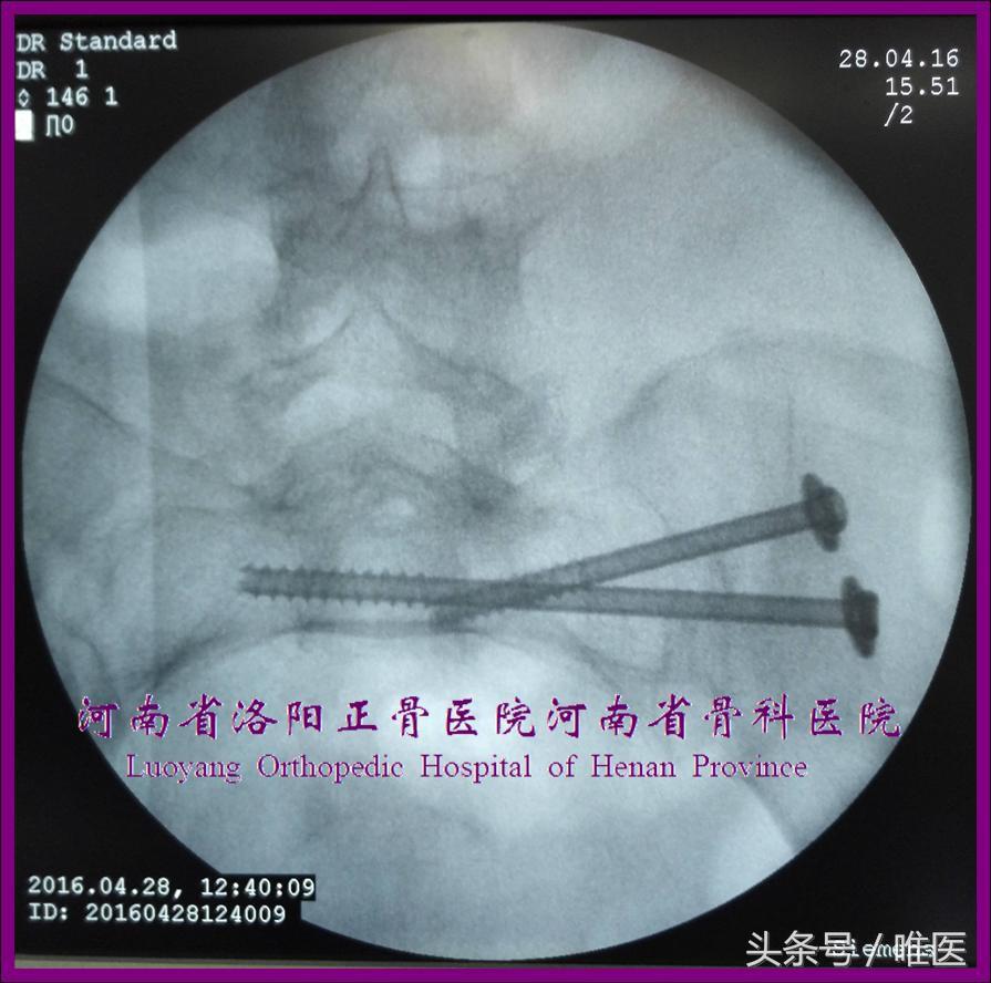 如何精准地置入骶髂螺钉——骨医小灶第二十一期（下）