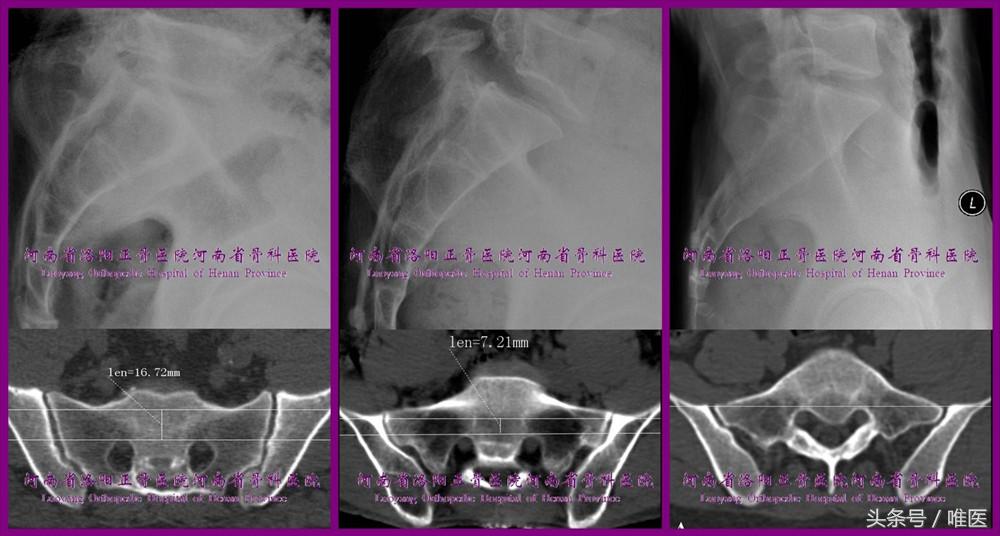 如何精准地置入骶髂螺钉——骨医小灶第二十一期（下）