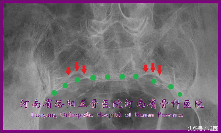 如何精准地置入骶髂螺钉——骨医小灶第二十一期（下）