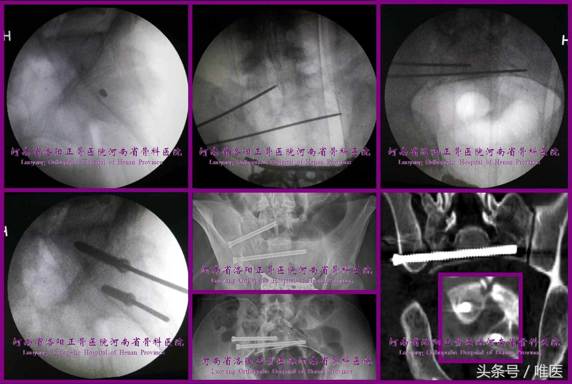 如何精准地置入骶髂螺钉——骨医小灶第二十一期（下）
