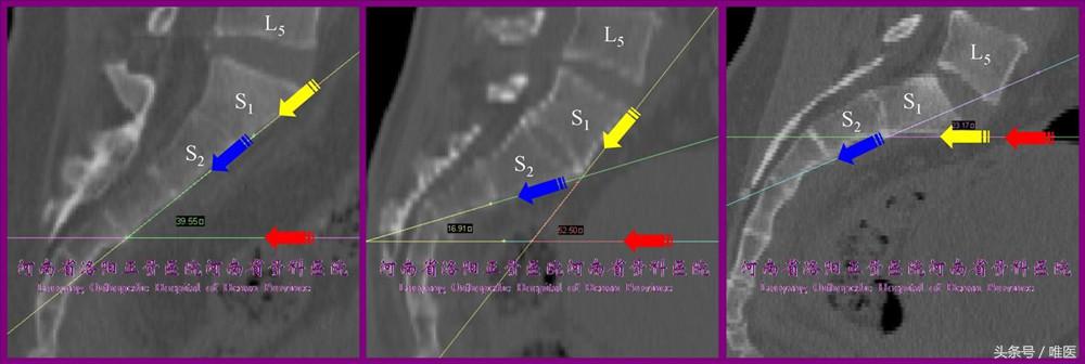 如何精准地置入骶髂螺钉——骨医小灶第二十一期（下）