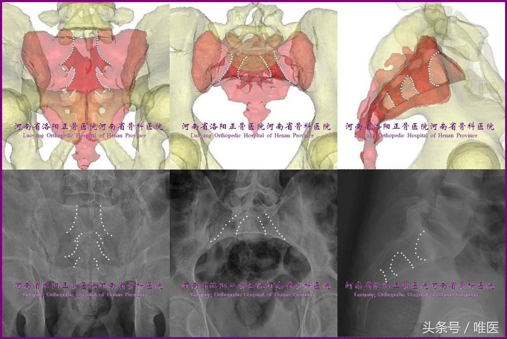 如何精准地置入骶髂螺钉——骨医小灶第二十一期（下）