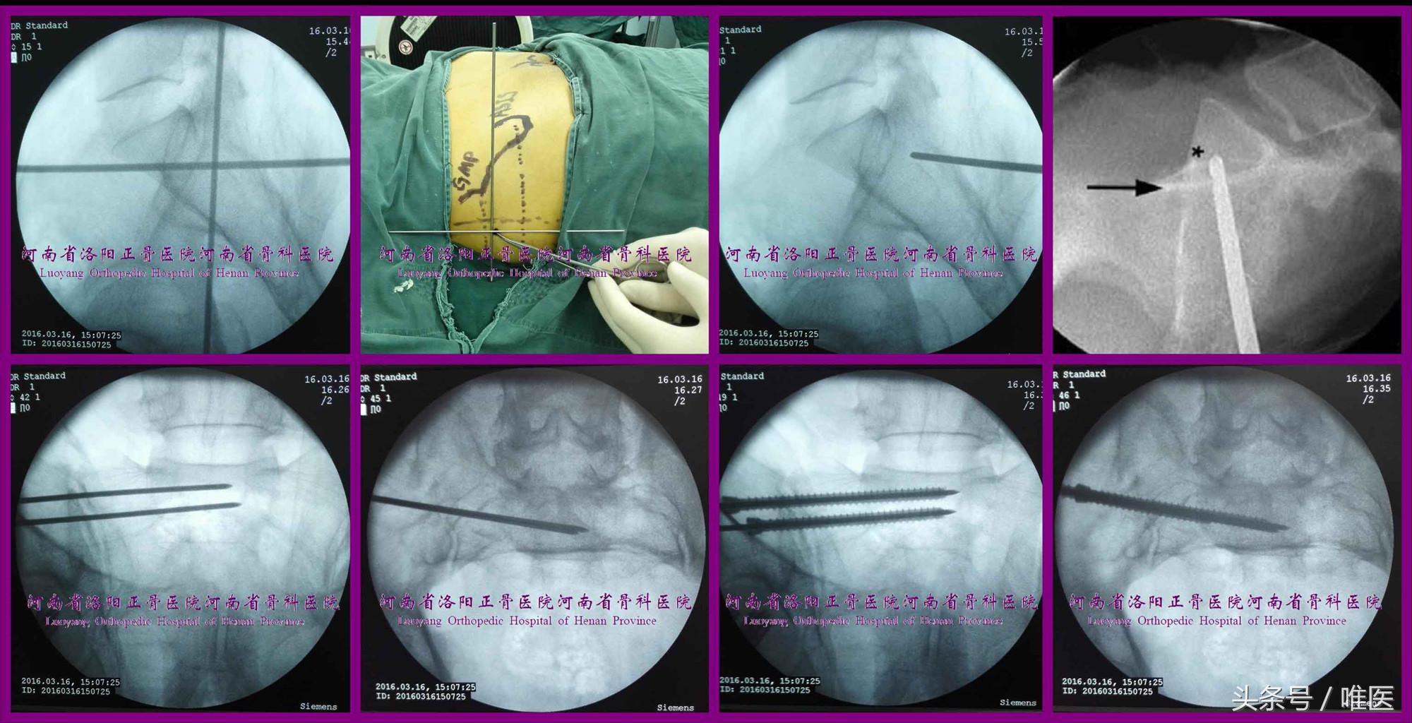 如何精准地置入骶髂螺钉——骨医小灶第二十一期（下）