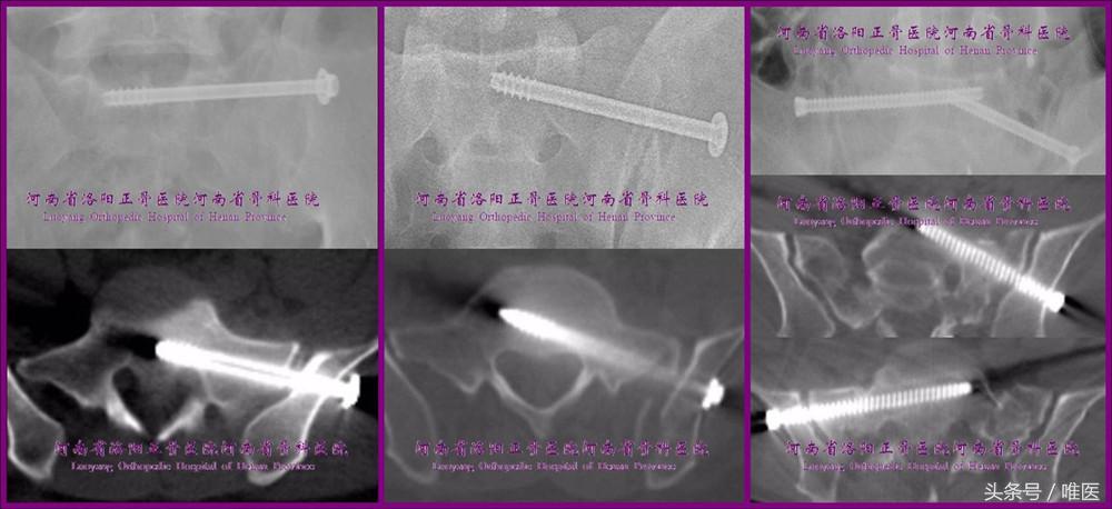 如何精准地置入骶髂螺钉——骨医小灶第二十一期（下）