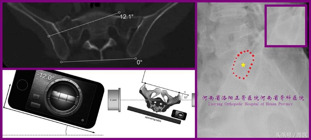 如何精准地置入骶髂螺钉——骨医小灶第二十一期（下）