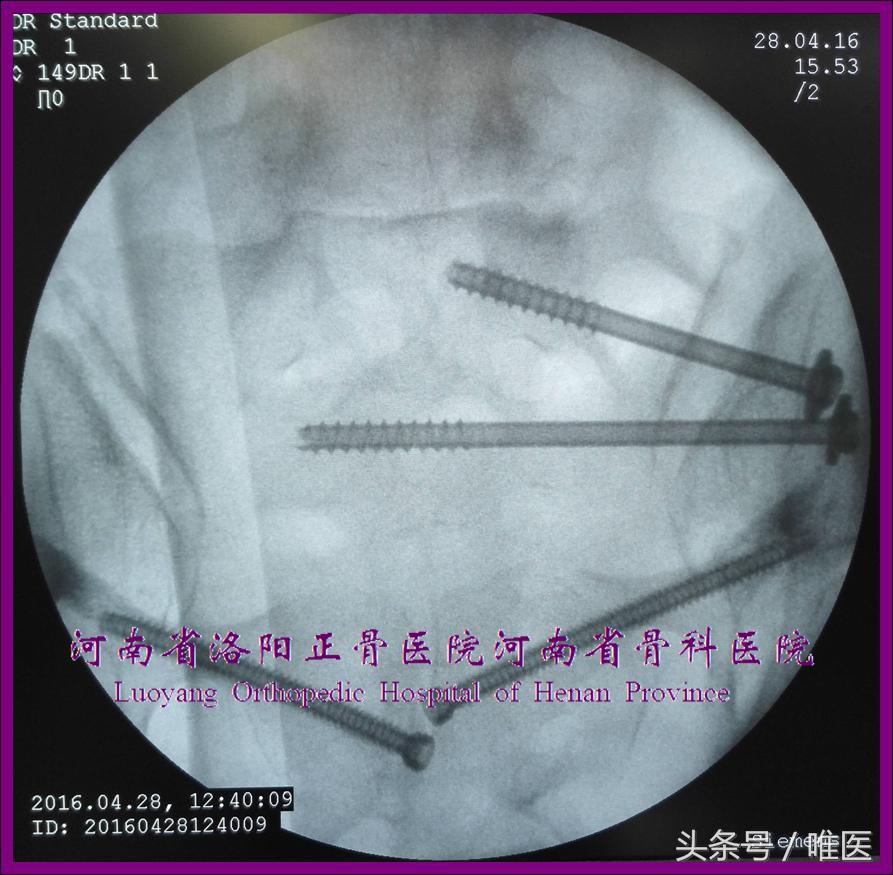 如何精准地置入骶髂螺钉——骨医小灶第二十一期（下）