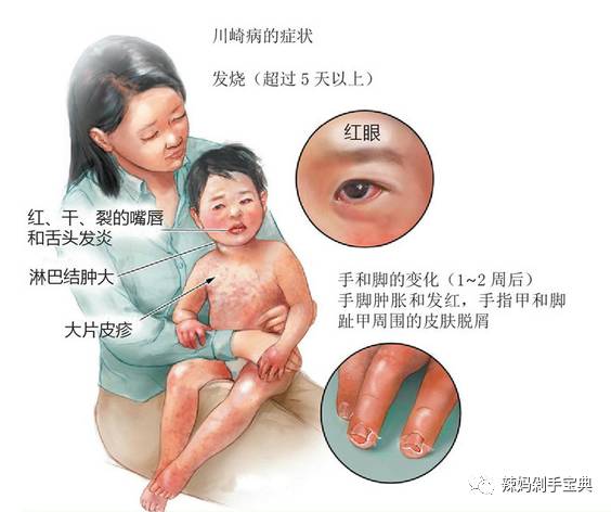 5岁幼儿发烧一定警惕川崎病，(很多妈妈不知道这种病)，宝妈真实分享试管宝宝得病经过