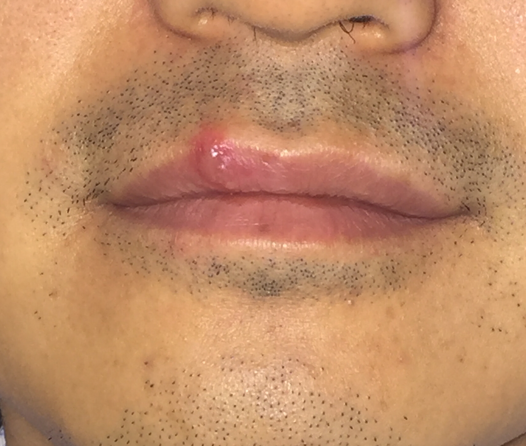 嘴唇起泡是什么原因引起的(加班加点熬夜喝酒应酬) - 百百科