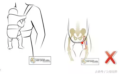 除了抱姿不对，宝宝这些东西选择不当，都会导致他髋关节发育不良