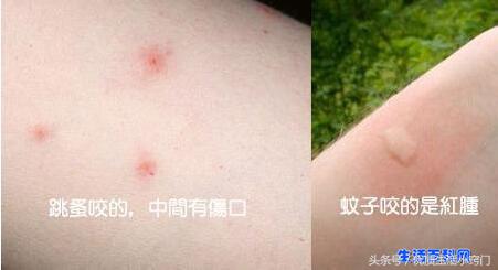 被跳蚤咬的癥狀圖片,被跳蚤咬的癥狀圖片擦什么藥