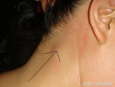 局部红肿压痛,按之坚硬,这就是患了淋巴结炎