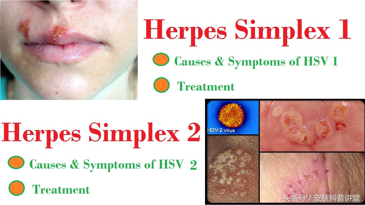 单纯疱疹(herpes simplex)由单纯疱疹病毒(hsv)感染引起的,临床上以簇