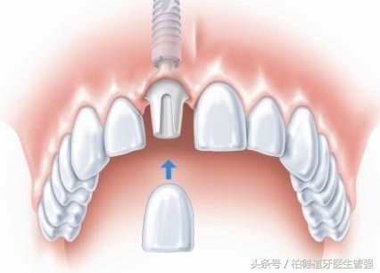 你“我”相识-详解种植牙基本常识