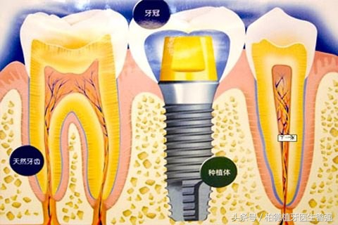 你“我”相识-详解种植牙基本常识