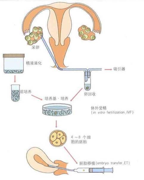 试管婴儿的流程、步骤和费用？