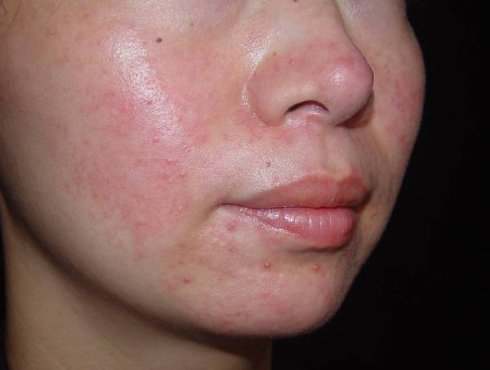 真实,可怕的激素脸差点毁了我的一生