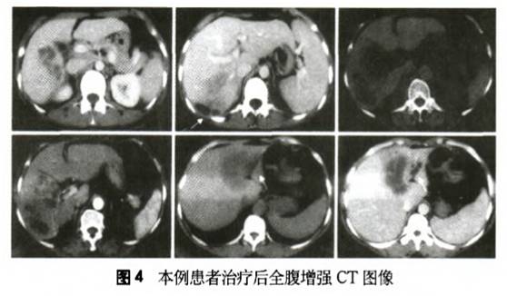 患者反复腹胀，嗜酸性粒细胞升高，提示什么疾病？